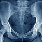Xray of pelvis
