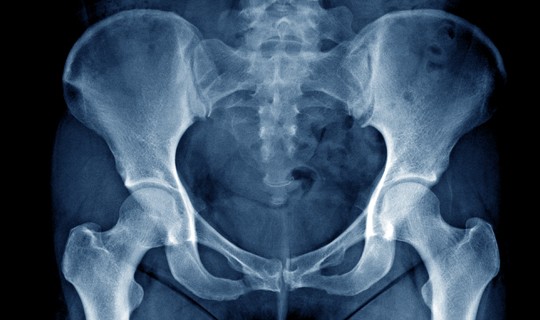 Xray of pelvis